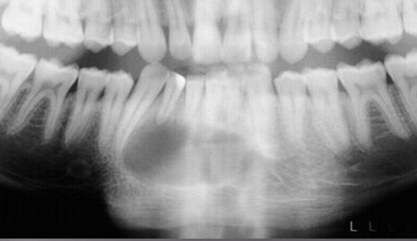 <p>thin, well-defined radiopaque rim of bone around radiolucent lesion</p>
