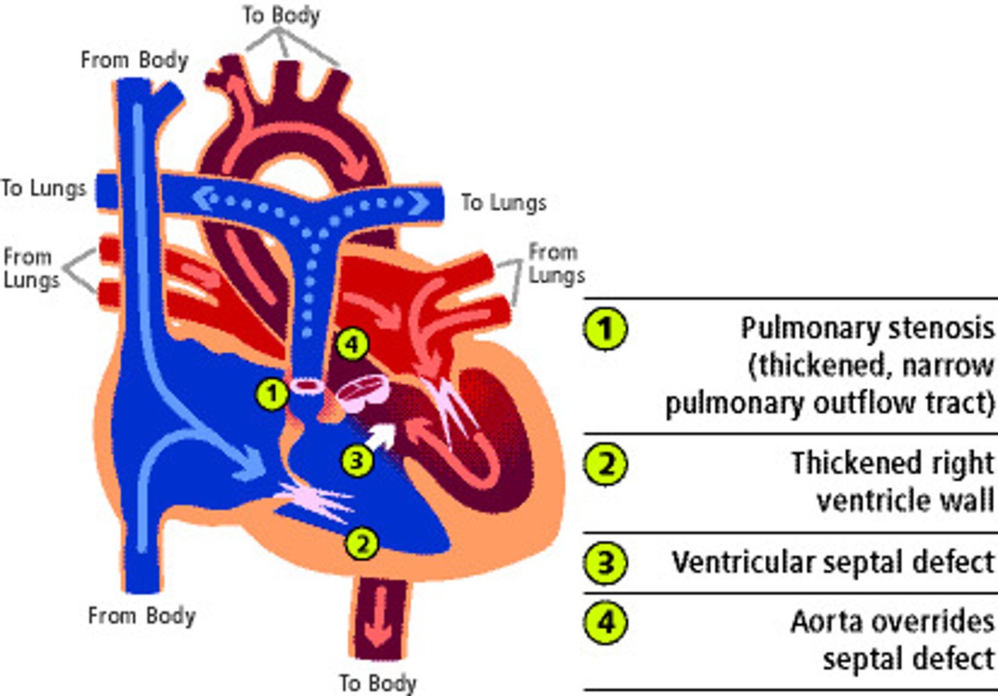 <p>congenital malformation involving four distinct heart defects (pulmonary stenosis, rt ventricular hypertrophy, VSD, overriding aorta)</p>