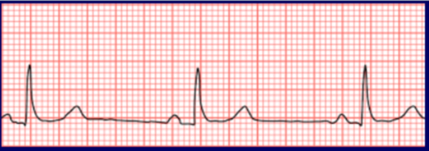 <p>Originate: SA node</p><p>QRS complex: narrow/wide</p><p>P wave: before QRS, same</p><p>Heart rate: &lt;60 bpm</p><p>R-R intervals: regular</p>