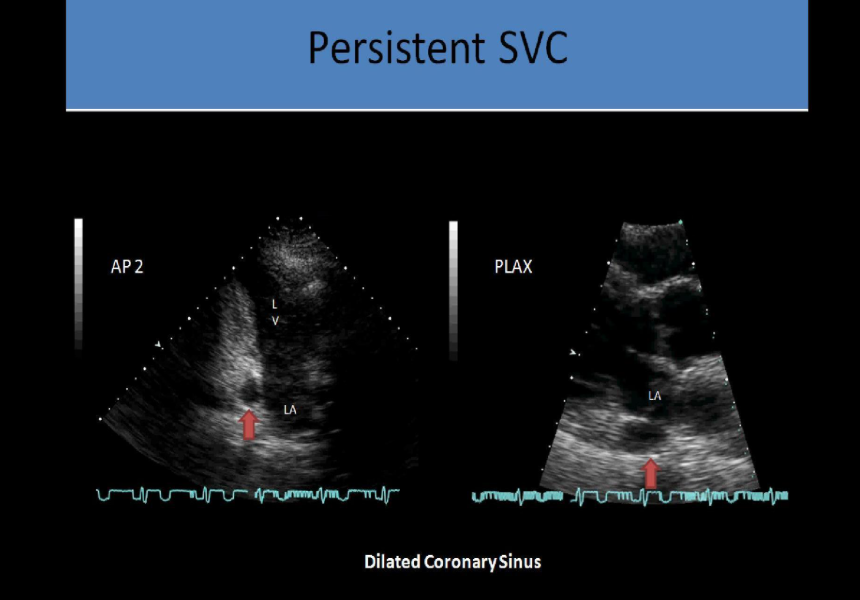 <p>plax view will demonstrate dilated coronary sinus between la and descending ao</p>