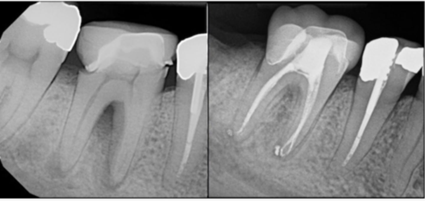 <p>What type of lesion?</p><p>- Tooth #30 CC: "There's a bump on my gums"</p><p>- Sinus tract near B sulcus</p><p>- Probing: 12mm MB, 7mm B</p><p>- CBCT shows furcation bone loss joining with PARL at M apex; separate PARL at D apex; crestal bone appears WNL</p><p>- Pulpal dx: Necrotic</p><p>- Periapical dx: Chronic apical abscess</p><p>- Apical and furcal bone healing observed at recall without additional periodontal treatment</p>