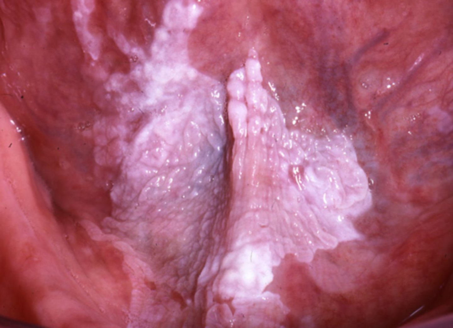 <p>PRECANCER</p>