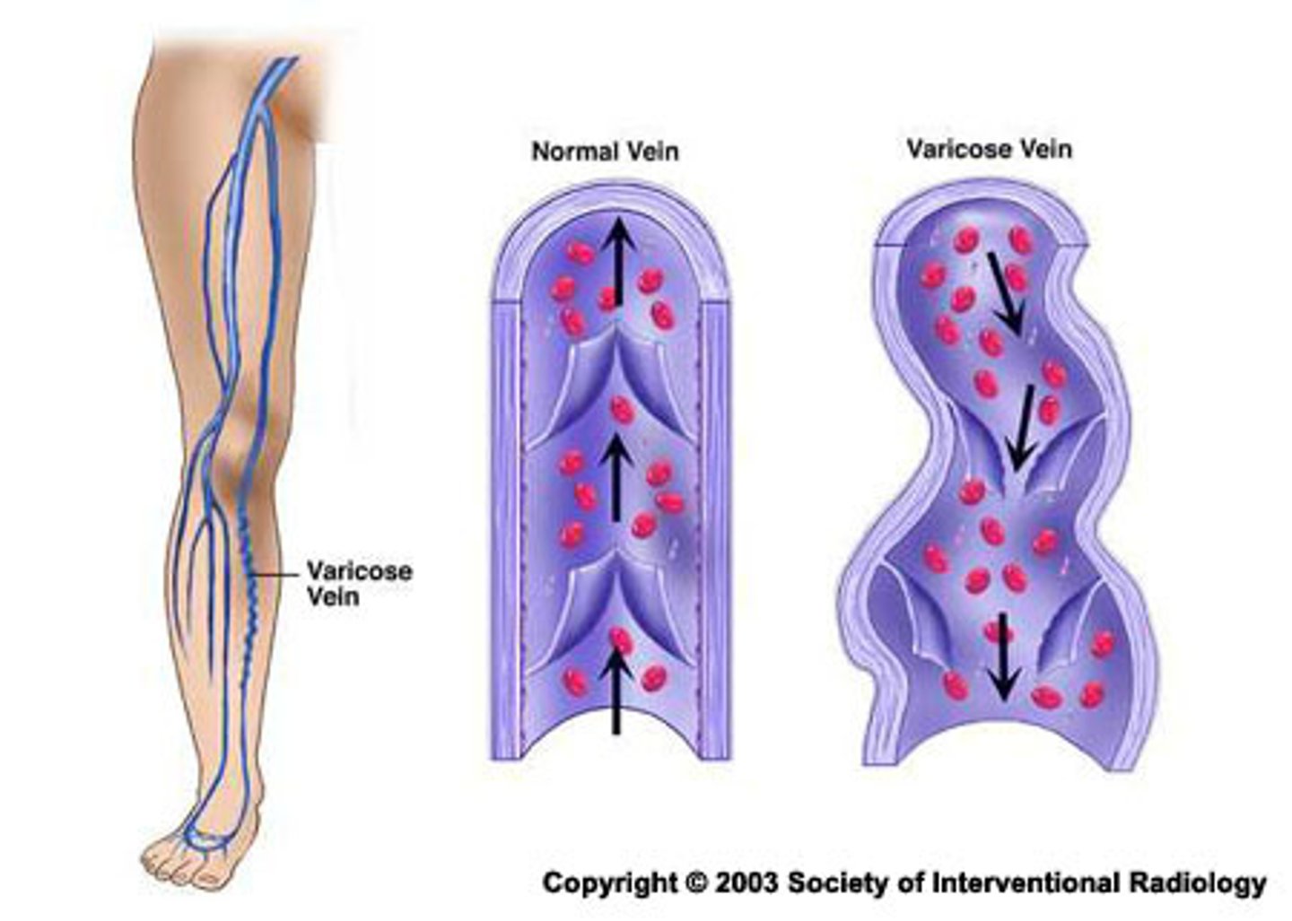 <p>results from incompetent venous valves, inadequate muscle action, or venous obstruction</p><p>- damaged or incompetent valves allow venous blood to pool and flow backward, leading to increased volume and pressure in the vessel (venous HTN)</p><p>- veins become enlarged and weak</p><p>- Risk factors: age, genetics, obesity, prolonged standing, sedentary lifestyle, smoking, female hormones and pregnancy</p>