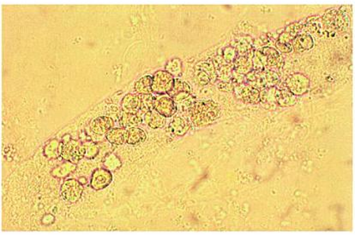 <p>what do epithelial cells contain?</p><p>what does it indicate? what are they seen with?</p>