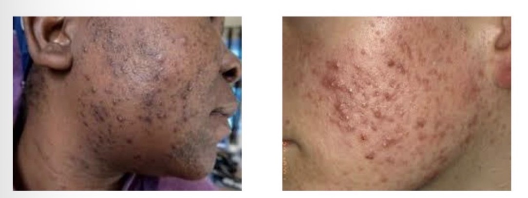 <ul><li><p>Chronic inflammatory condition </p></li><li><p>Common in teenagers, onset at puberty, hormonal changes</p></li><li><p>Lasts few months to several years</p></li><li><p>Affects mainly face, back and chest</p></li><li><p>Increased keratin and sebum causes blockages of hair follicle, causes comedowns, papules, pustules </p></li><li><p>Complications: scarring, hyperpigmentation, depression anxiety</p></li></ul><p></p>