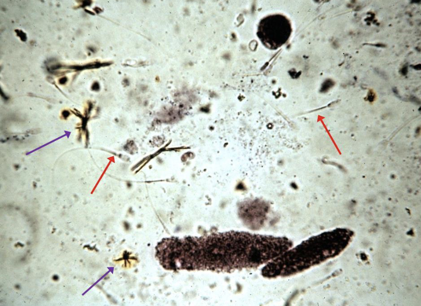 <p>What type of cast is seen in this slide?</p><p>What are the <span style="color: red"><strong>red</strong></span> arrows pointing to?</p><p>What are the <span style="color: purple"><strong>purple</strong></span> arrows pointing to?</p>