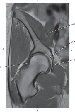 <p>Which line is pointing to the iliofemoral ligament?^</p>