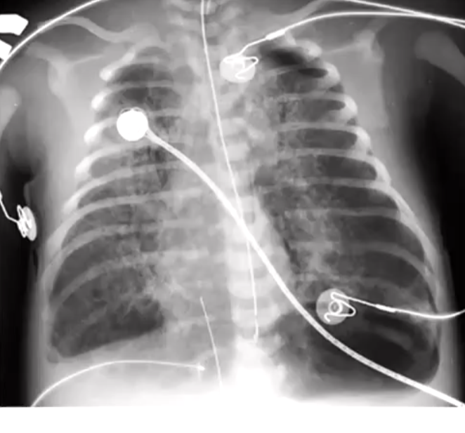 Small left-side of heart, left diaphragm is lower, left side is more translucent