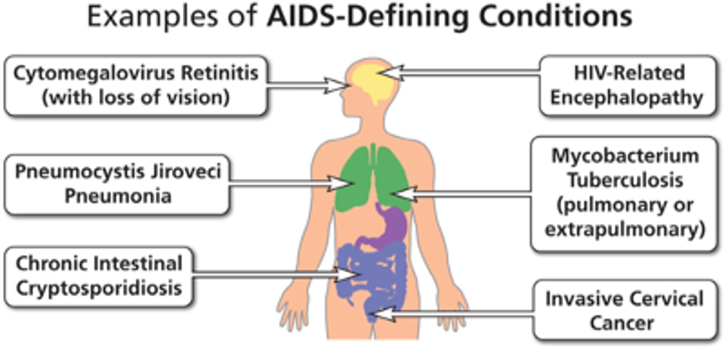 <p>AIDS is an outcome of chronic uncontrolled HIV infection</p><p>Defined as CD4+ <200 cells/microL or the presence of any AIDS-defining condition</p><p>In the absence of effective ART, the median survival of patients with advanced HIV infection (CD4+ <50 cells/microL) is 12-18 months</p>