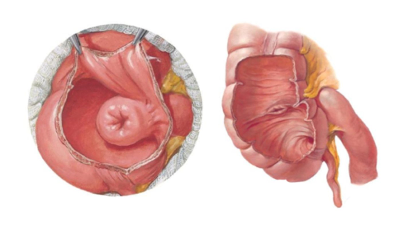 <p>Ileocecal valve</p>