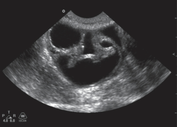 <ul><li><p>abdominal pain</p></li><li><p>increased abdominal girth</p></li><li><p>abnormal vaginal bleeding</p></li><li><p>palpable pelvic mass</p></li><li><p>small and hard to detect on pelvic exam</p></li></ul><p></p>