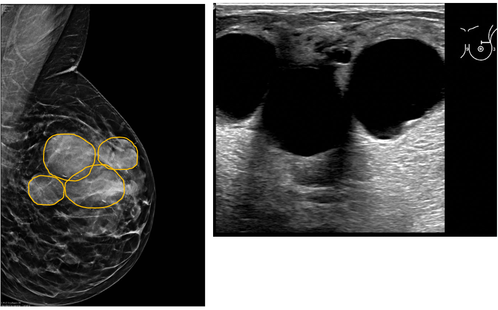 <p>Patient history: palpable left breast masses in a 48-year-old patient </p><p>Modality: left image – mammogram of left breast in MLO view; right image – US of left breast (upper lateral quadrant), high frequency (7-12 MHz) linear transducer </p><p>Region: left breast</p><p>Radiologic sign:: Multiple, well-defined masses in the left breast that show up as anechoic lesions with acoustic enhancement on the ultrasound. </p><p> Diagnosis multiple cysts in the left breast</p>