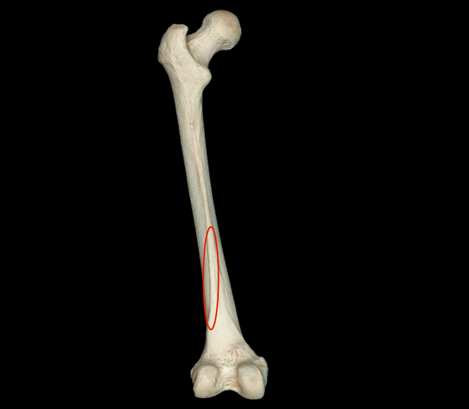 <p>lateral edge of “posterior border” of femur</p>