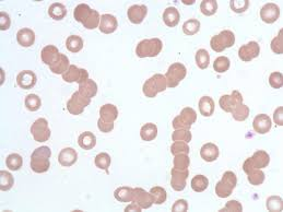 <p>rouleax</p><p>stacking of RBC</p>