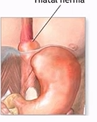 <p>part of the stomach pokes up through the diaphram, the oesophagus can move through, become trapped, can be serious as vunrable to infection and damage, sometimes fixes itself, sometimes surgery is required&nbsp;</p>
