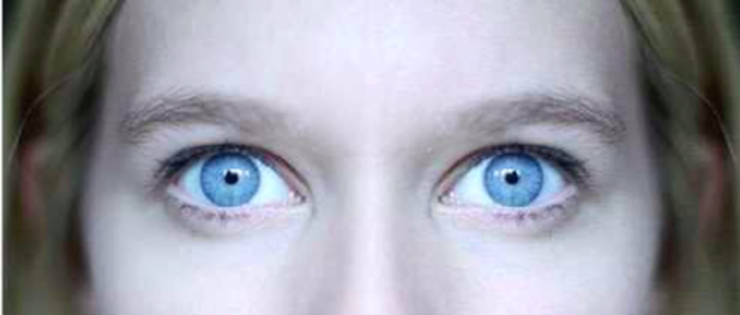 <p>Fixed and constricted pupils. May occur with use of narcotics, damage to pons, or result of treatment for glaucoma</p>