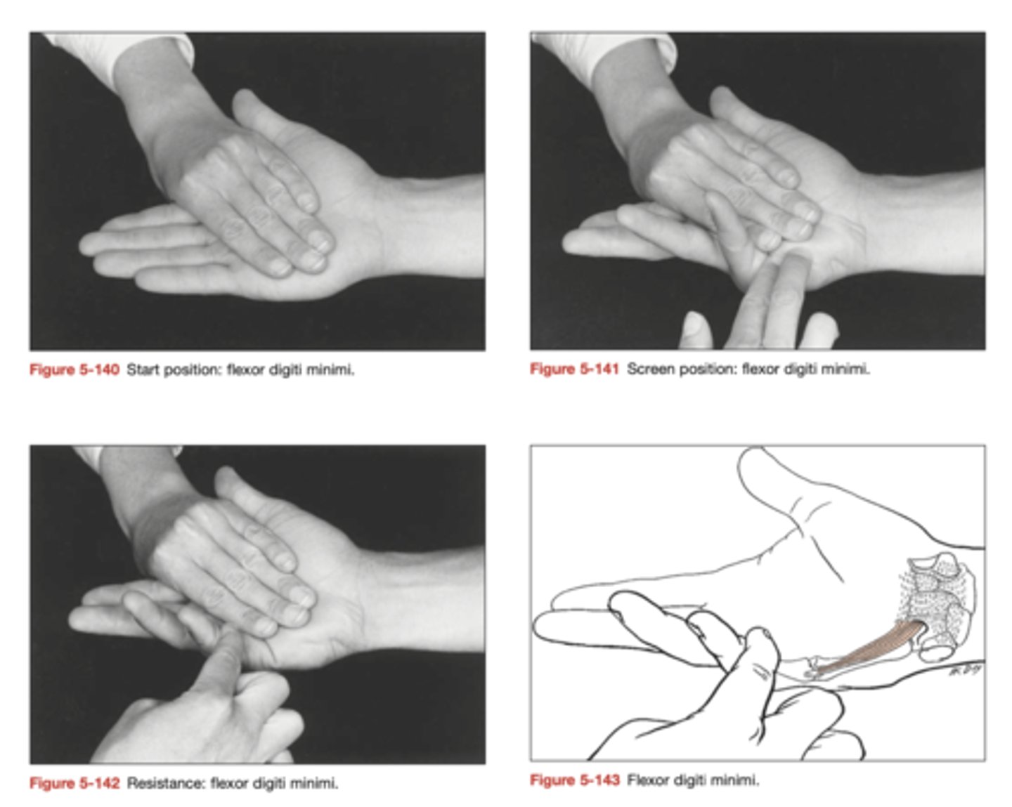 <p>Muscles: Lumbricals 1,2,3,4, Dorsal interossei (digits 2-4), Palmar interossei (digits 2,4,5), FDS, FDP, &amp; FDM</p><p>Patient Position: Sitting with hand elevated and forearm supported in supination or propped on elbow; wrist neutral; MCP flexed, PIP and DIP extended (intrinsic hand position)</p><p>Stabilize: Volar &amp; dorsal aspect of distal metacarpals</p><p>Resistance: Volar aspect of proximal phalanx and dorsal aspect of middle or distal phalanx</p><p>Compensations: Wrist flexion tenodesis (wrist extension may produce passive finger flexion)</p>