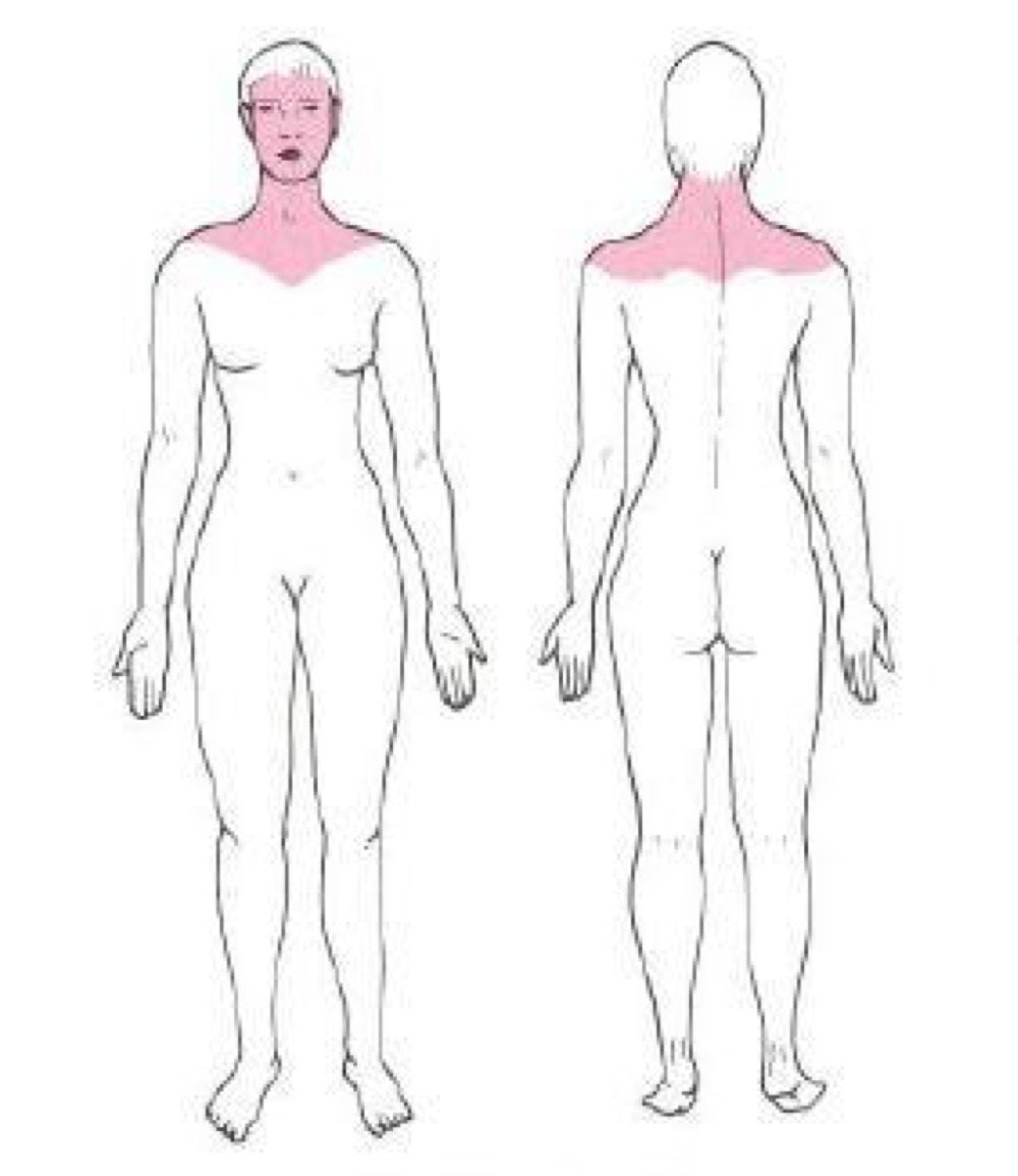 <p>what distribution of skin lesion is this </p>