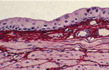 <p>stretched or unstretched bladder </p>