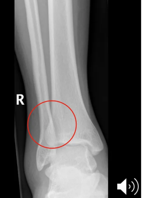 <p>A fibrous joint, more stable than a synovial joint.</p>