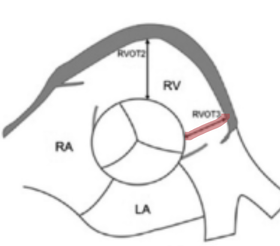 <p>Using PSAX Ao measure RVOT near the <u>PV annulus</u></p>