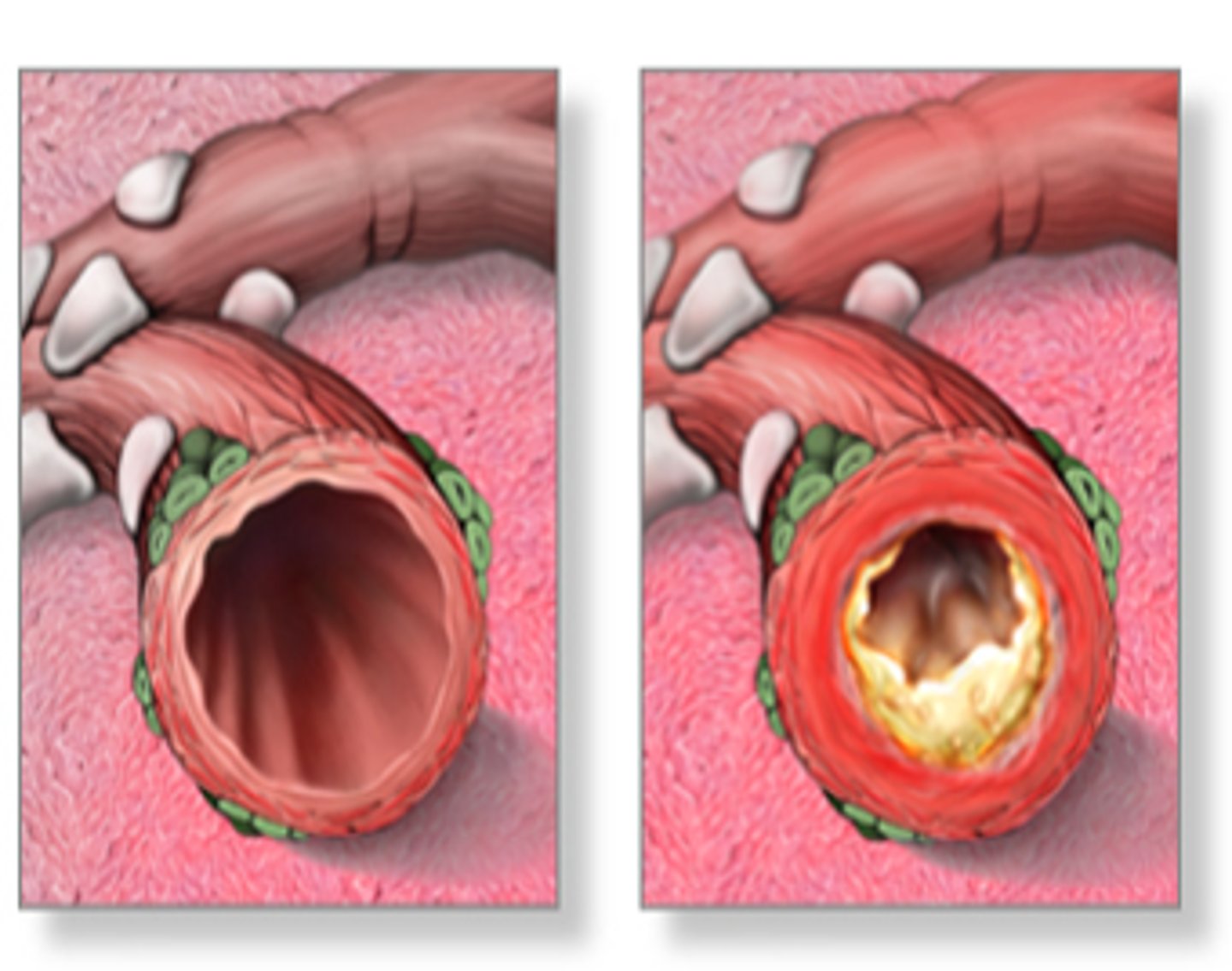 <p>-lower respiratory infection</p><p>-inflammation of the tracheobronchial tree or large bronchi</p>