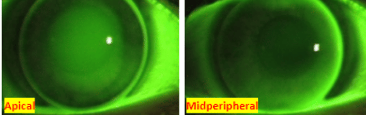 <p>fluorescein pattern observed when there is space between the lens and cornea because the lens is steeper than the corneal curvature. Results in a plus powered lacrimal lens</p>