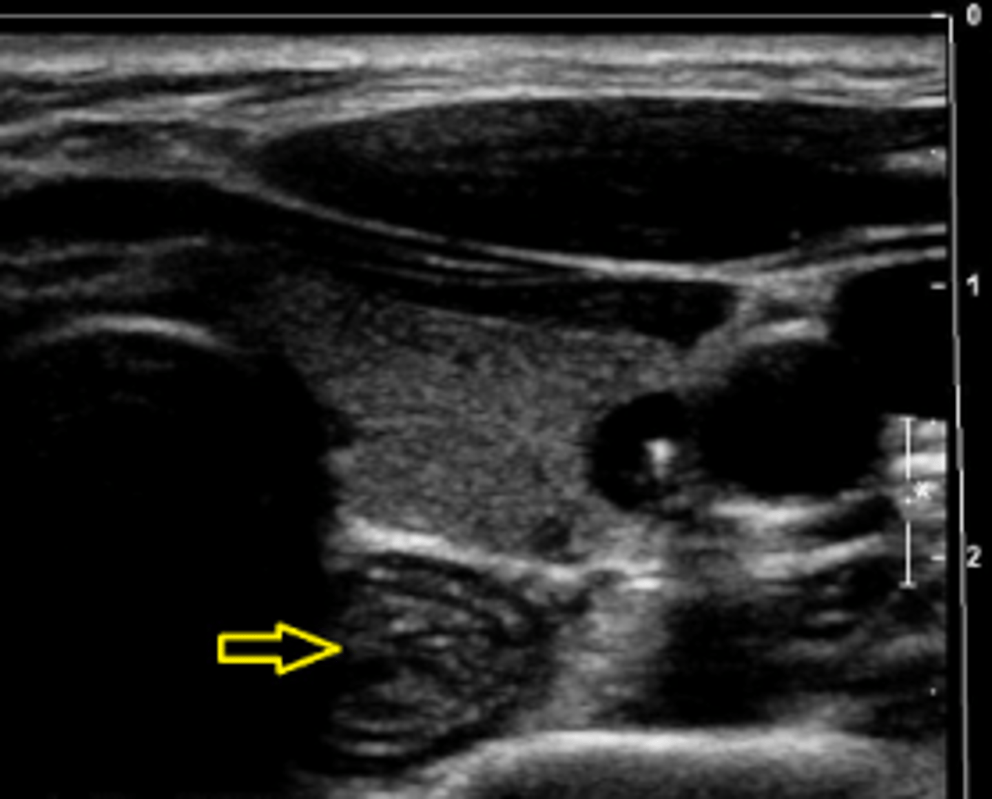 <p>Esophagus</p>