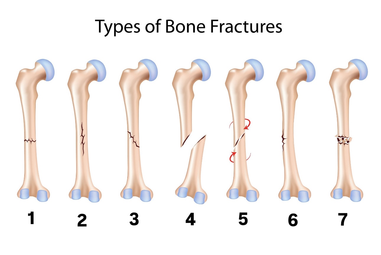 <p>What fracture is labeled “5”?</p>