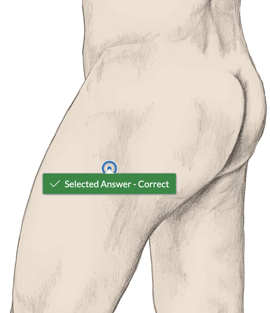 <p>lateral side of upper thigh</p>