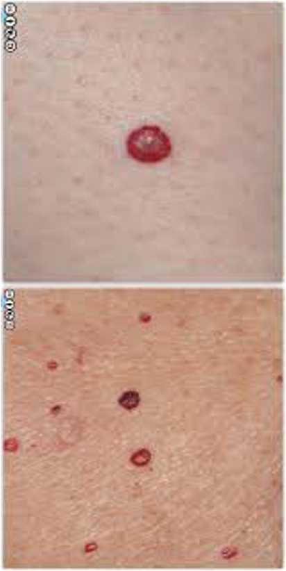 <p>what lesion appears as red, purple, blue, or black lagoons under a dermatoscope?</p>