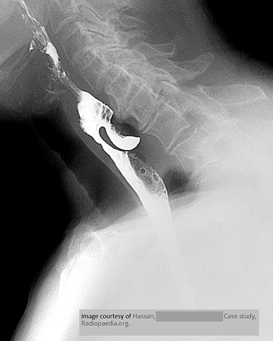 <p>What is the gold-standard imaging study for Zenker’s diverticulum?</p>