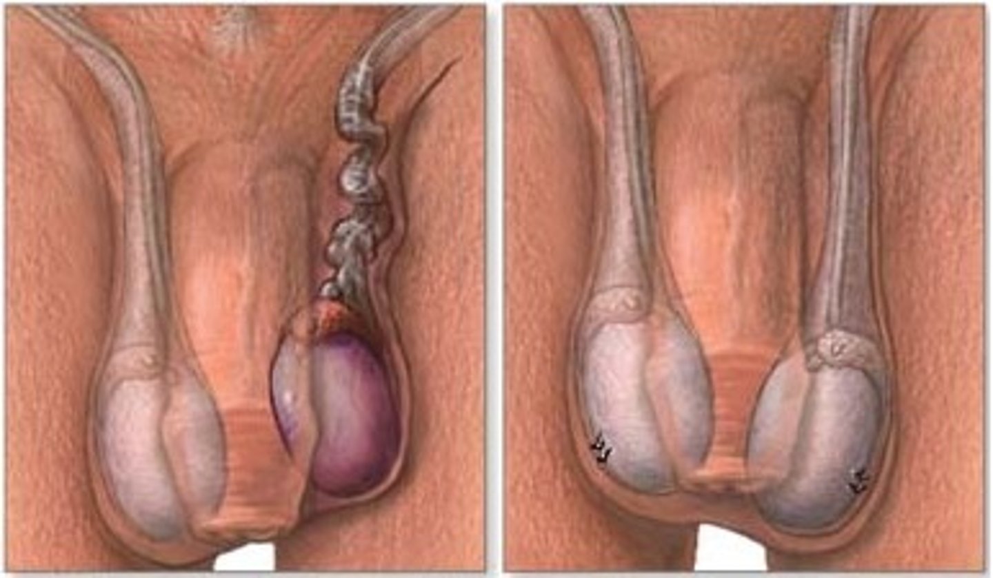 <p>twisting of spermatic cord upon itself</p>