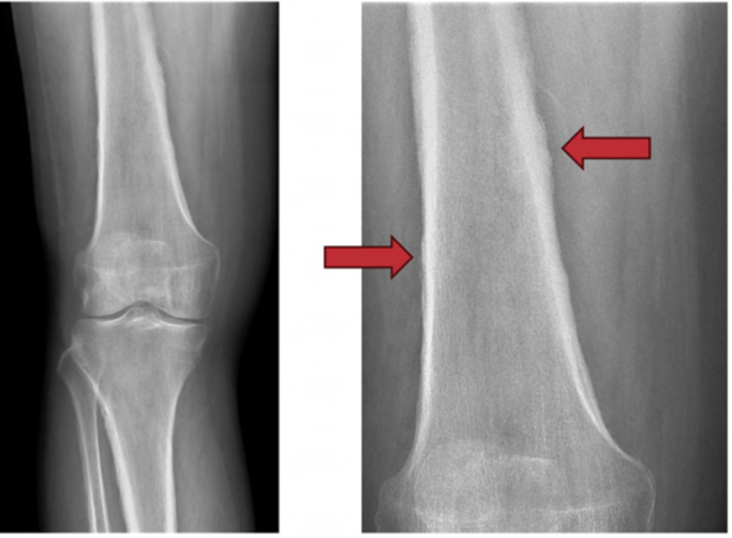 <p>This condition, Hypertrophic Pulmonary Osteoarthropathy (HPOA) is very common with ____ _____. What should the next step for management be?</p>