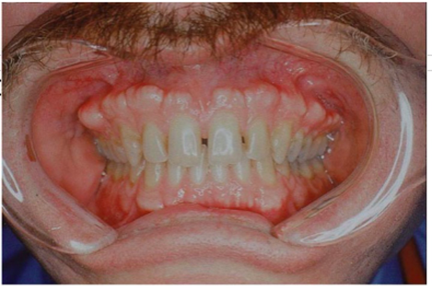 <p>bony growth (benign) arising from the surface of bone</p>
