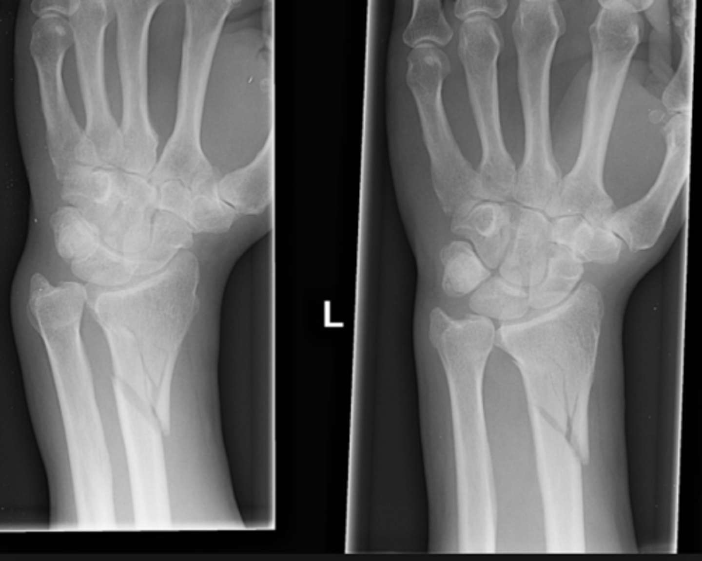 <p>Lady presents with a painful swelling over the lower end of the forearm following a fall.</p><p>Imaging: distal radial fracture with disruption of the distal radio-ulnar joint.</p><p>FOOSH + rotational force</p><p>Ex: bruising, swelling and tenderness over the lower end of the forearm.</p><p>XR: displaced # radius and a prominent ulnar head due to dislocation of the inferior radio-ulnar joint.</p><p>Fracture type?</p>