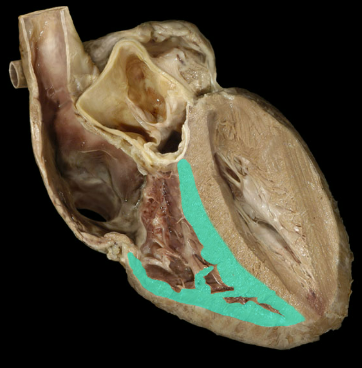 <p>Myocardium (of L ventricle)</p>