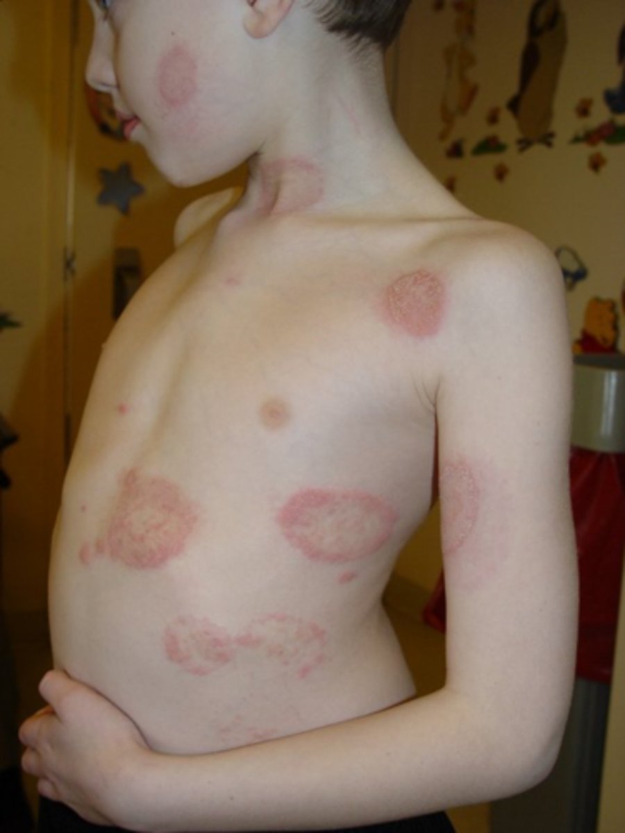 <p>Ringworm, fungal infection of the body</p>