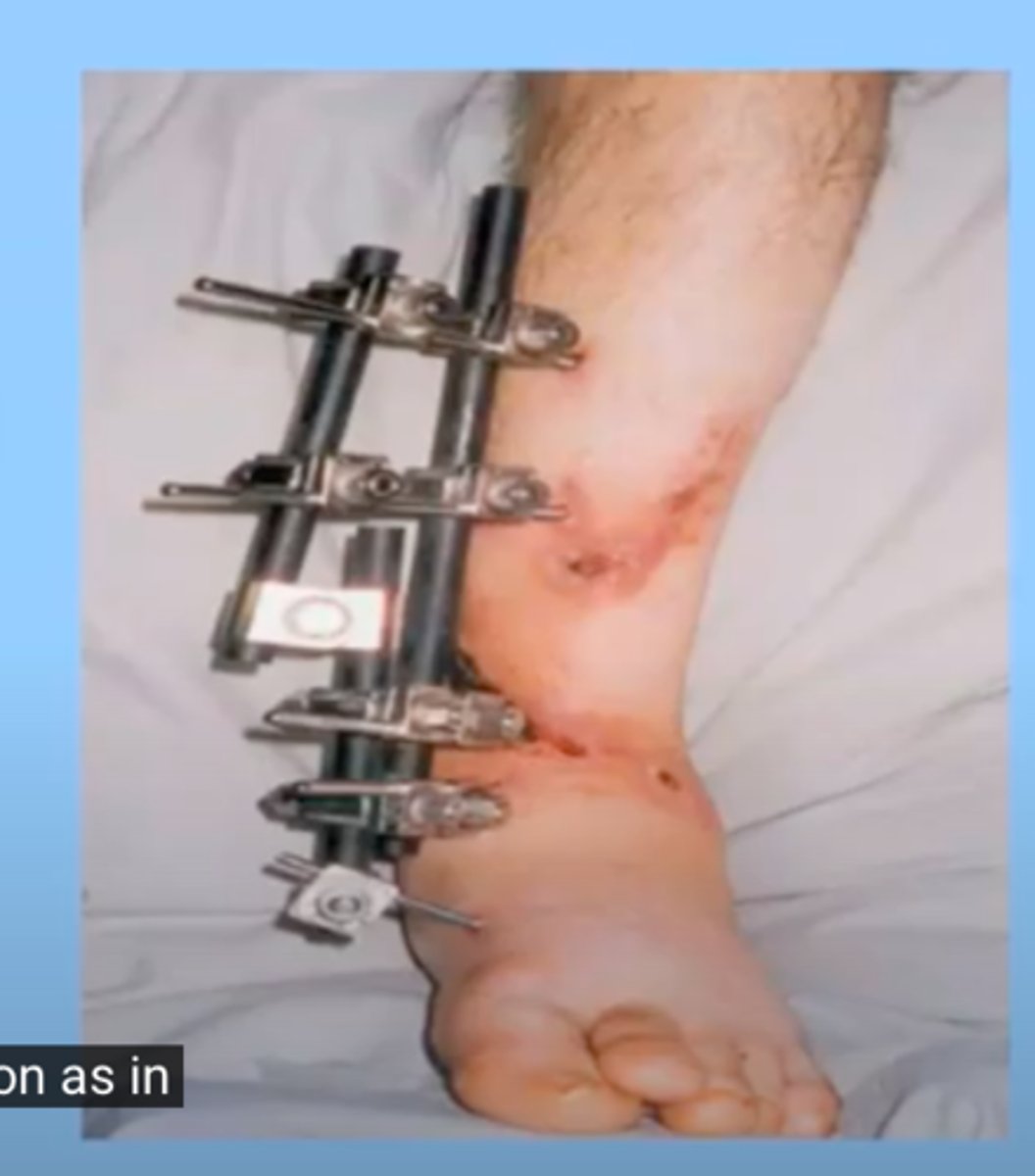 <p>the usage of devices that go right through the skin to immobilize</p>