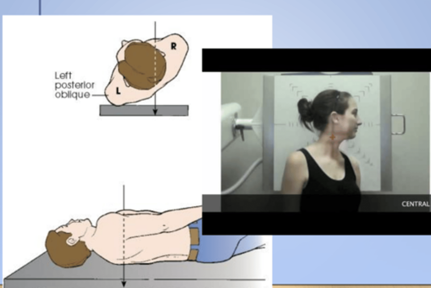 <p>X radiographic position of chest results in AP oblique projection.</p>