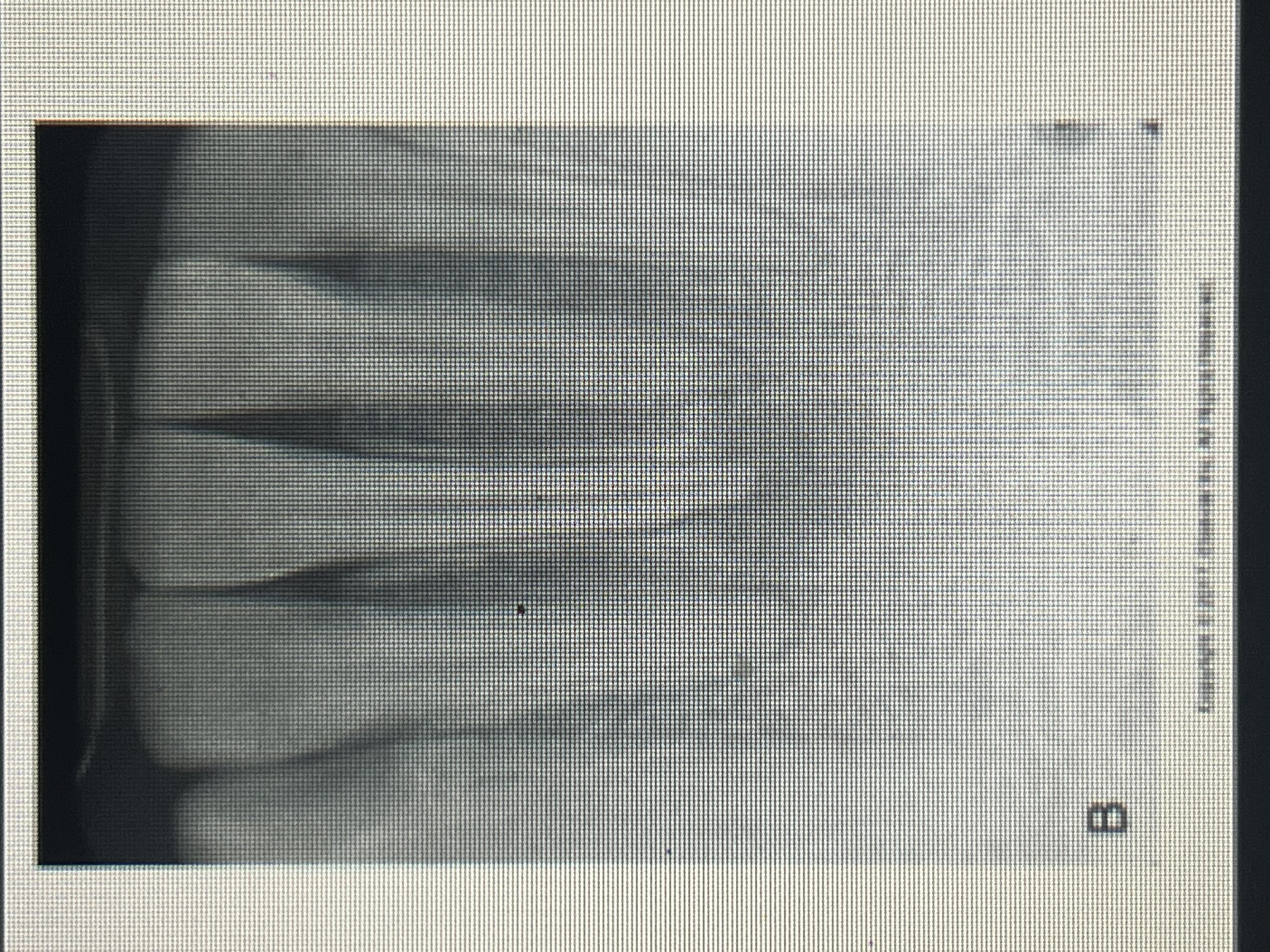 <p>A lesion located around the apex of a tooth.</p>