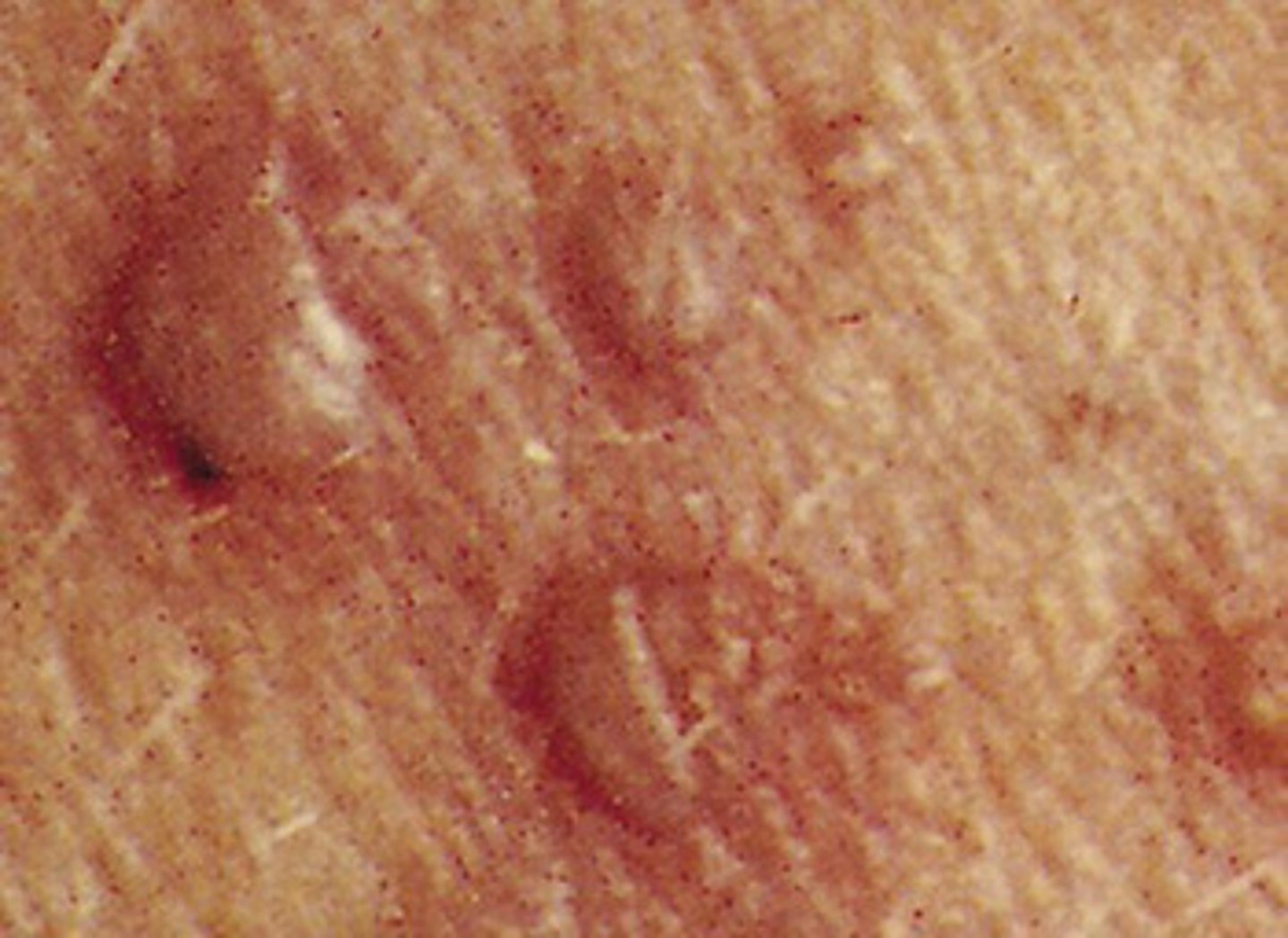 <p>a small, raised blister that contains clear fluid inside or under the epidermis</p>