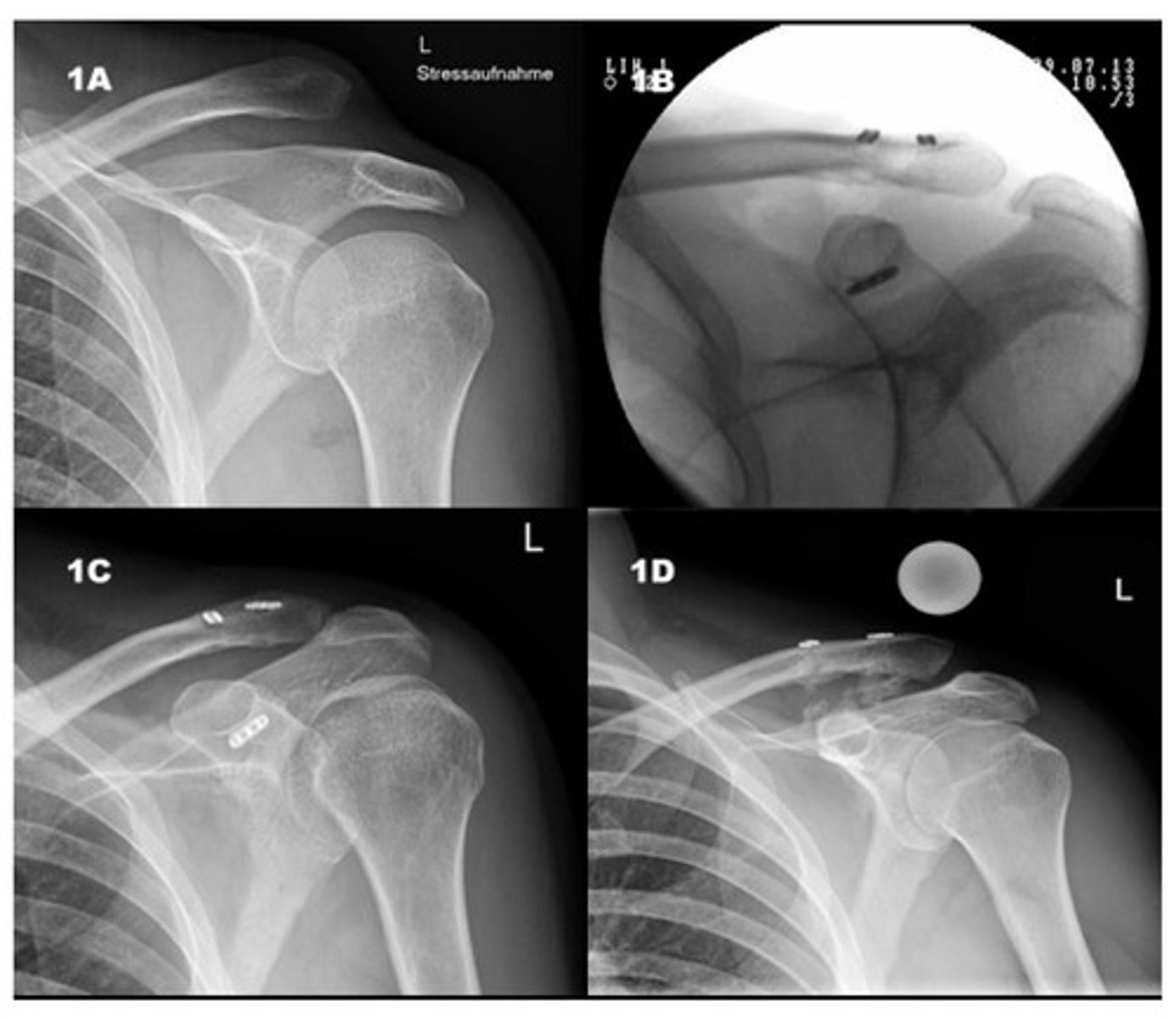 <p>persistent shoulder pain that's worse with overhead activity</p><p>seen on XR, MRI, or US with inferior osteophytes at AC joint and cephalad migration of humeral head</p>