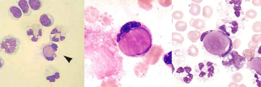 <p>A. Identify the abnormality / cell</p><p>B. This is seen in what condition / disease</p>