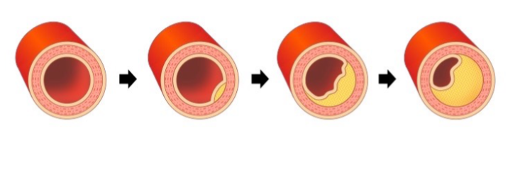 <p>-occlusion = cholesterol buildup blocking BV</p><p>-can lead to heart attack, cardiac arrest</p>