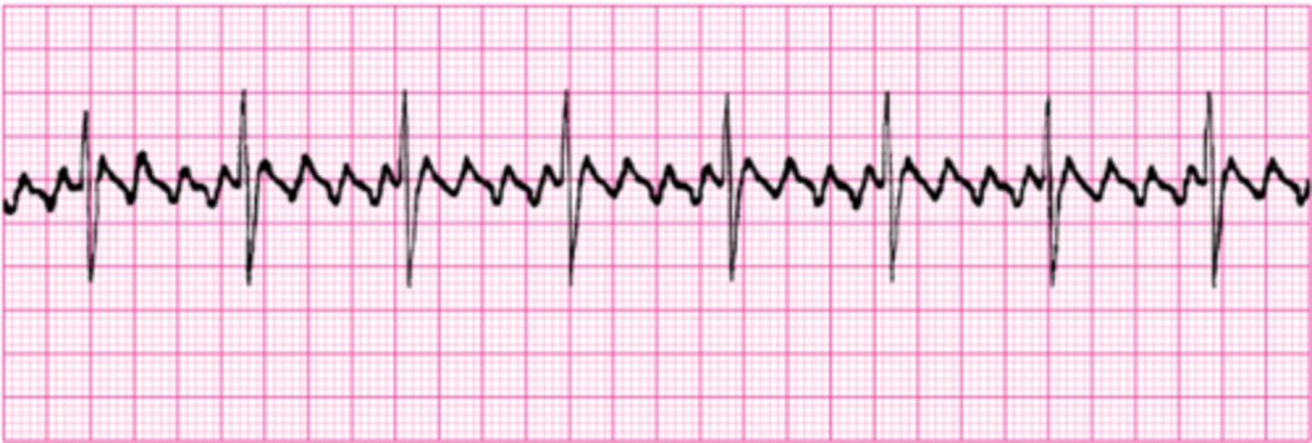 <p>Consistent atrial depolarization waves creating "flutter" or "saw-tooth" appearance on baseline.</p><p>Can be regular or irregular.</p><p>QRS complexes can be 'wide' or 'narrow'</p><p>Different ratios (2:1, 3:1, 4:1) possible</p>