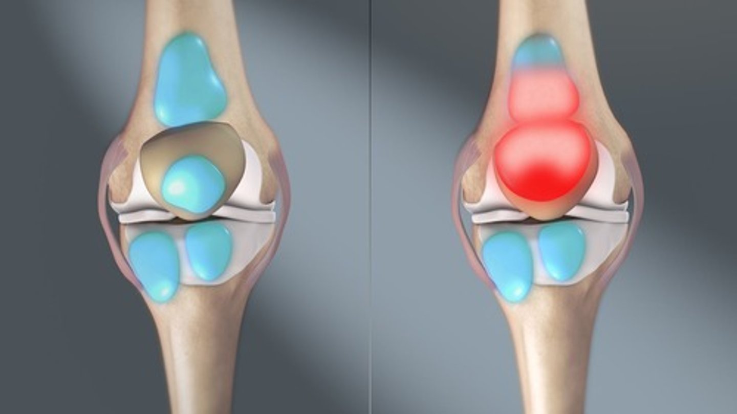 <p>condition where articular cartilage breaks down, leading to joint pain.</p>