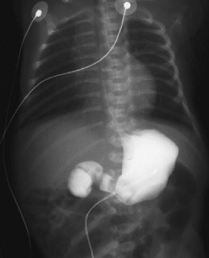 <ol><li><p><strong>Una mujer de 24 años, G2, P1001, se somete a una ecografía de control en la semana 17 de gestación y muestra polihidramnios. Da a luz un niño a término sin alteraciones en la exploración. Desde su nacimiento ha vomitado con frecuencia tras las tomas. La figura corresponde a los hallazgos de la radiografía con contraste realizada al lactante. Las pruebas de laboratorio revelan cifras de sodio de 130 mmol/l; de potasio de 3,4 mmol/l; de cloruro de 85 mmol/l; de CO2 de 32 mmol/l; de glucosa de 65 mg/dl, y de amilasa de 15 UI/l. ¿Cuál es el diagnóstico más probable?</strong></p><p>A. Pancreatitis aguda</p><p><strong><mark data-color="blue" style="background-color: blue; color: inherit">B. Páncreas anular</mark></strong></p><p>C. Pancreatitis crónica</p><p>D. Adenoma de células de los islotes</p><p>E. Adenocarcinoma de páncreas</p><p>F. Estenosis pilórica</p></li></ol><p></p>