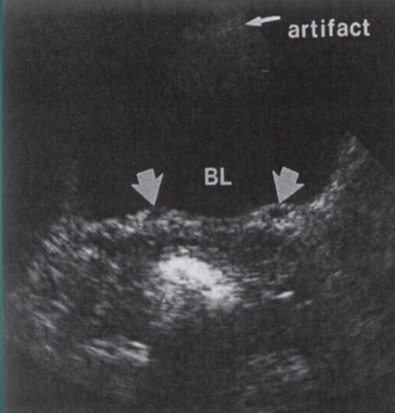 <p>Two small bumps on the posterior aspect of the bladder on either side of midline </p>