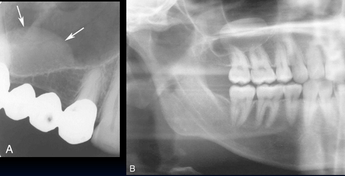 <p>-dome-shaped swelling beneath sinus mucosa</p><p>-localized, submucosal accumulation of fluid forming a sessile, dome-shaped swelling along a sinus border</p><p>-pediatric and adult population- common incidental radiographic finding</p><p>-typical site: floor of maxillary sinus</p><p>-typical behavior: benign, innocuous, spontaneous resolution</p><p>-do not touch!</p><p>-may be <em>weakly</em> correlated to allergy season</p><p>-if wanting to do a sinus lift, can send to ENT for decompression</p>